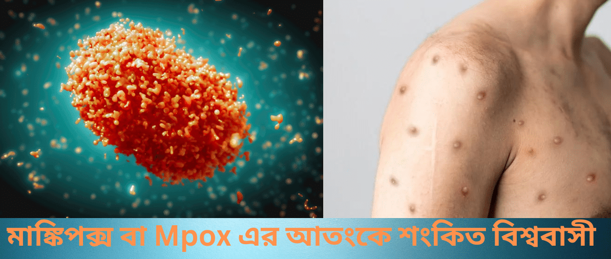 মাঙ্কিপক্স বা Mpox