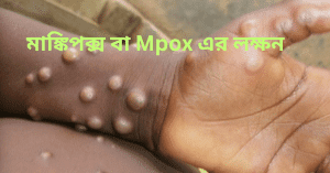 মাঙ্কিপক্স বা Mpox